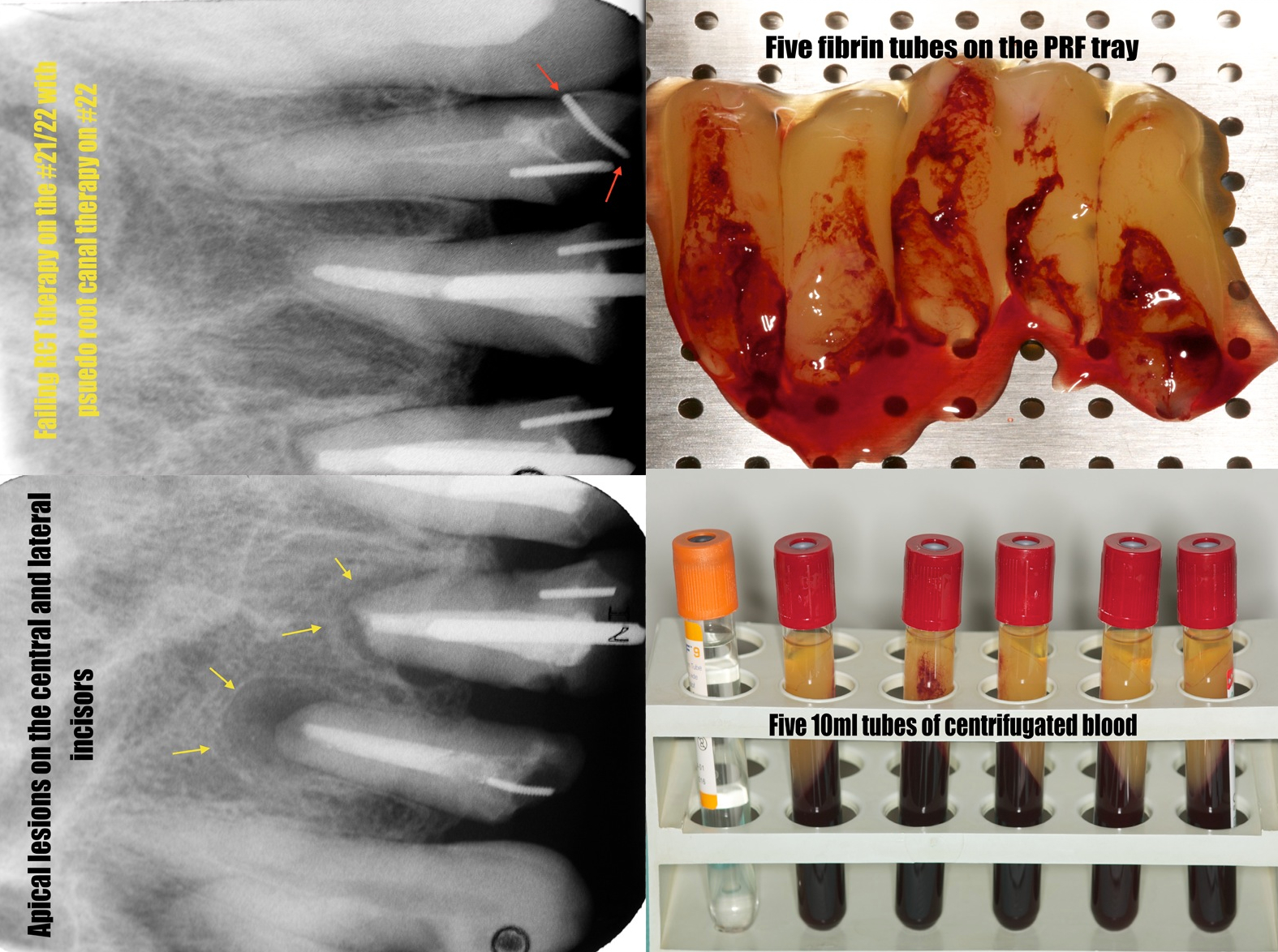 APRF+ Socket Preservation Victoria, British Columbia Dr. Cliff